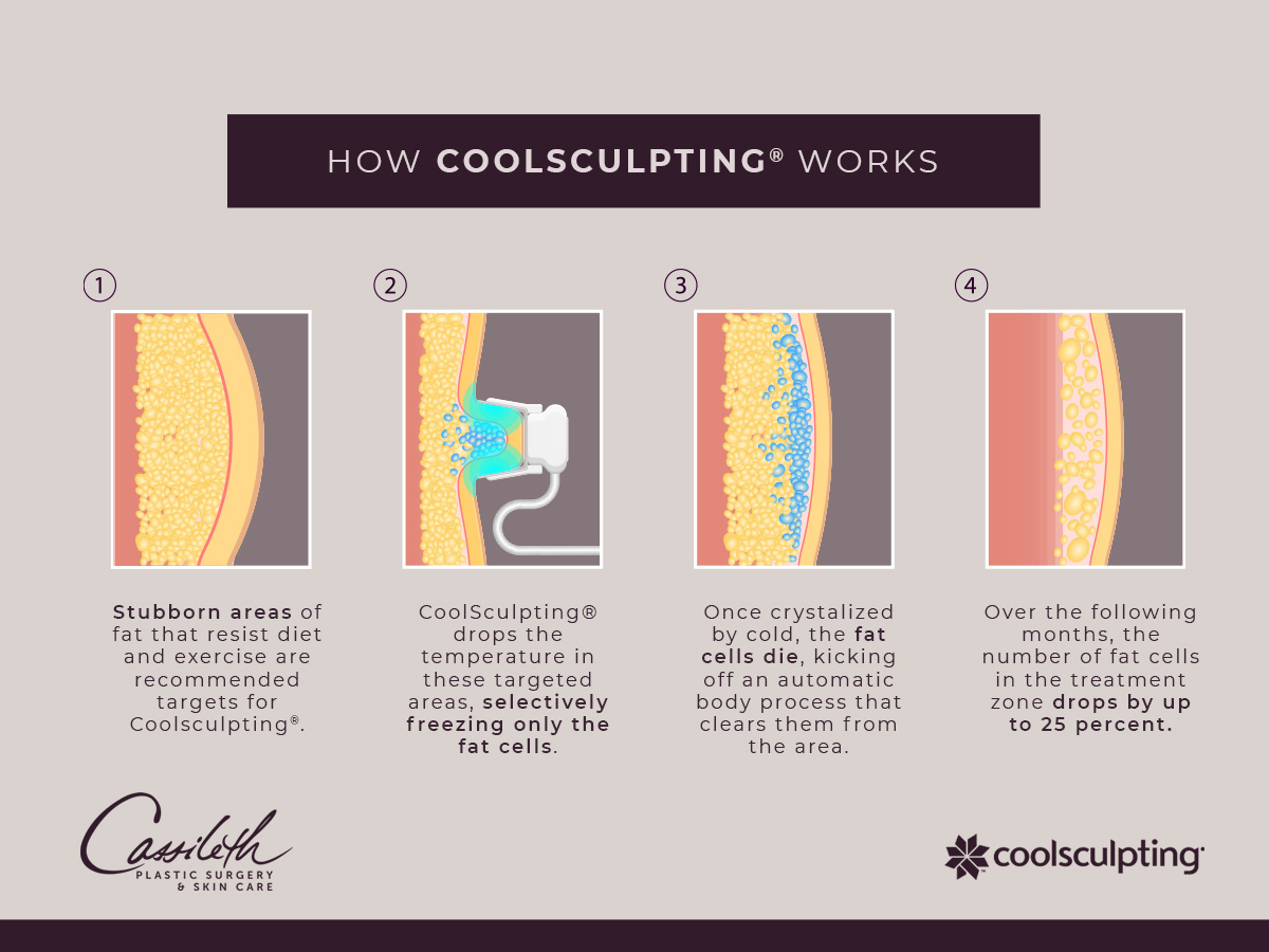 Get Rid of Bra Fat Flanks With Coolsculpting Beverly Hills, Los Angeles