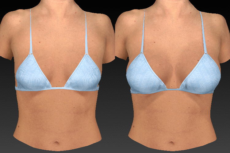3D Breast Portrait Simulation Tampa Bay