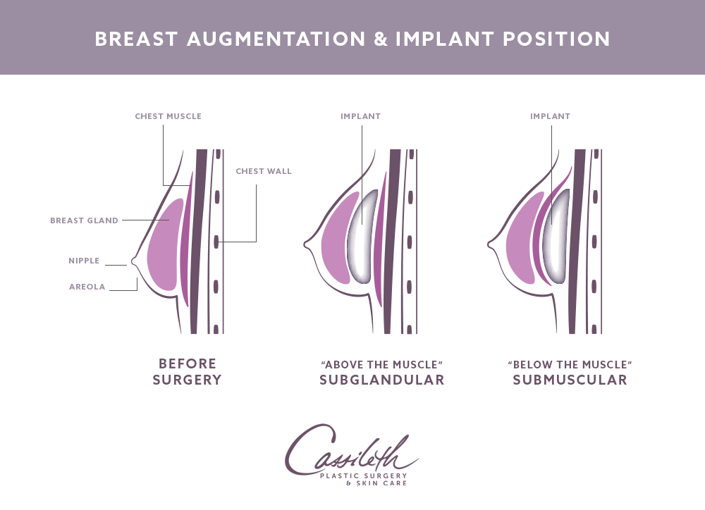 Double-bubble breast after reconstruction with silicone implant. a