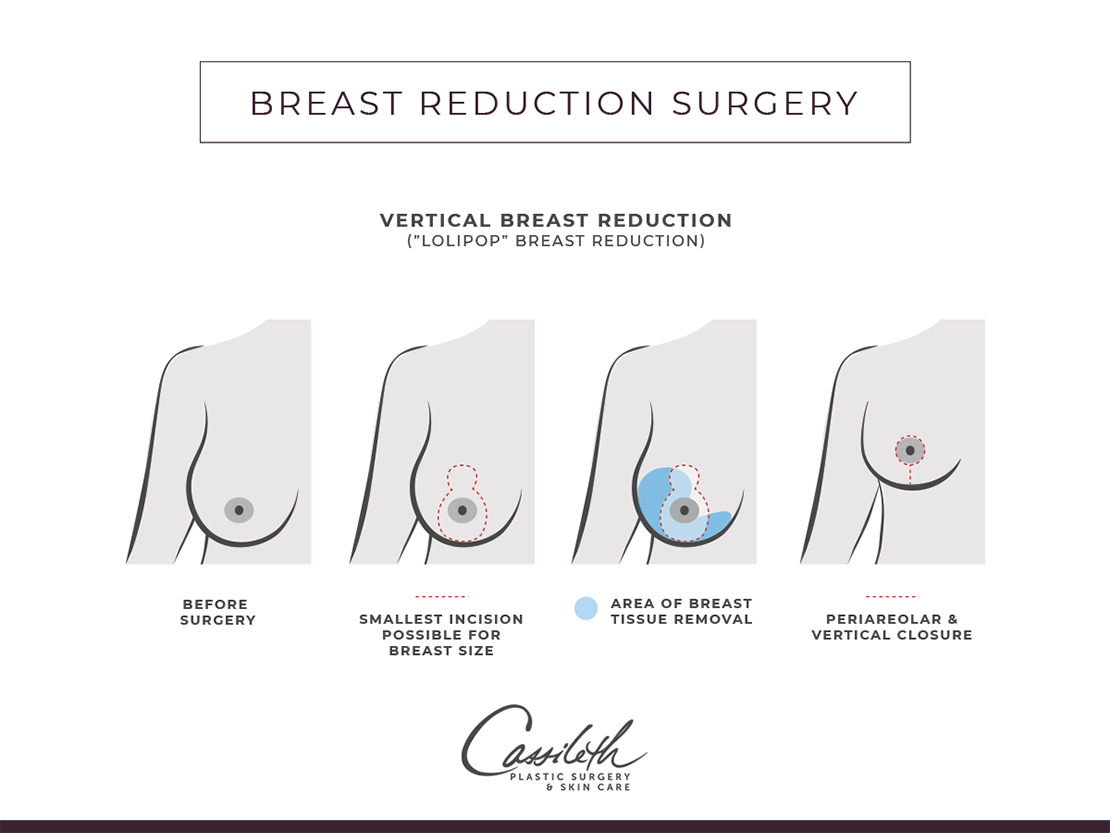 What are the Insurance Requirements for a Breast Reduction?