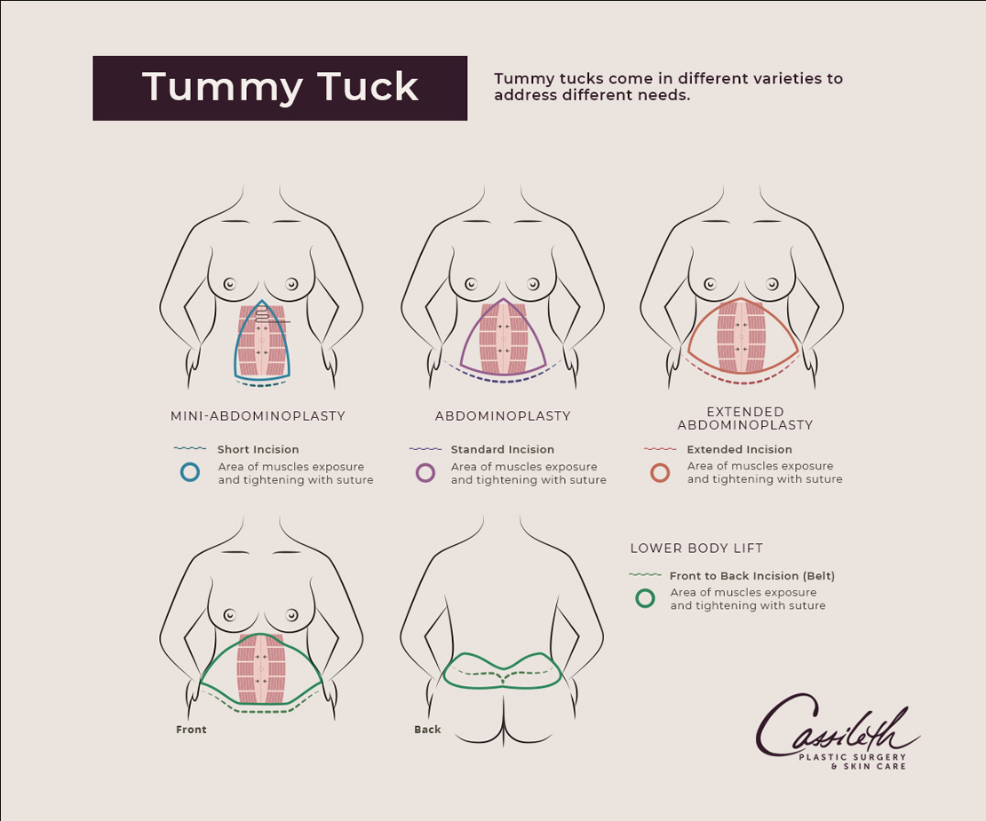 Tummy Tuck Revision Surgery - Moein Surgical Arts