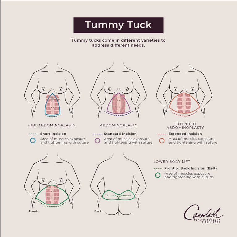 Tummy Tuck, abdominoplasty or tummy tuck is a cosmetic surgical procedure  performed to make the abdomen thinner and more firm. Surgery