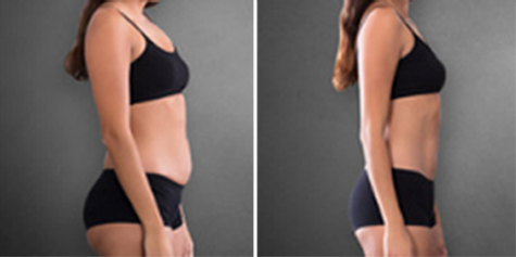 Kristen's Laser Bra Breast Reduction in the Beverly Hills Area 