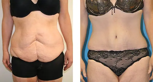 before and after of tummy tuck procedure