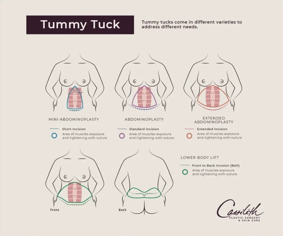 types of tummy tuck graphic