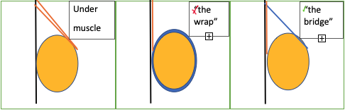 Breast implant placement chart